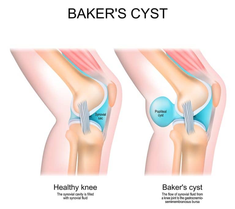 Baker S Cyst My Physio My Health