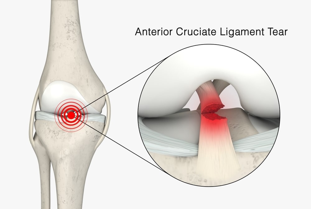 ACL Injury - The Comprehensive Guide to Anterior Cruciate Ligament