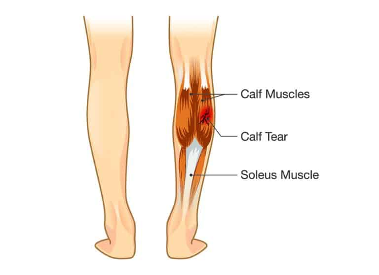 calf-tear-my-physio-my-health