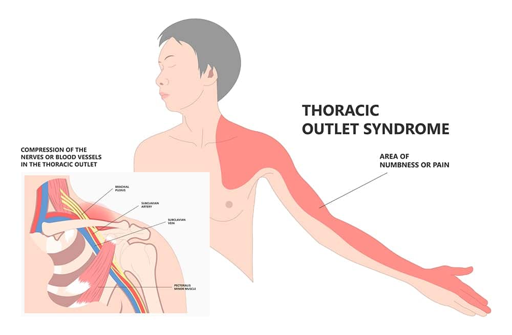 thoracic outlet syndrome exercises stretches